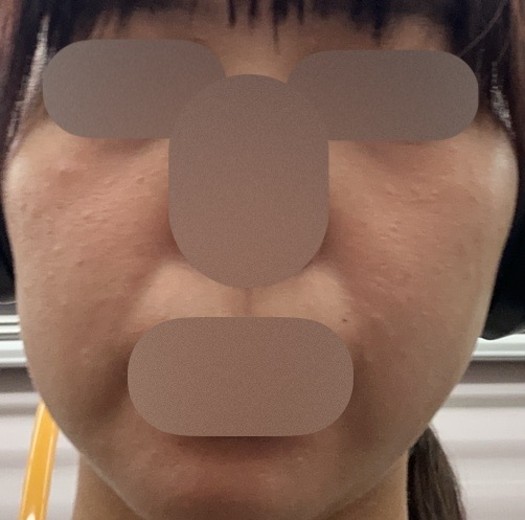 before photo: ダーマペン