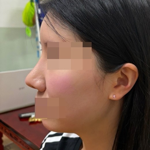 after photo: 코재수술, 콧대(보형물), 복코교정(수술)