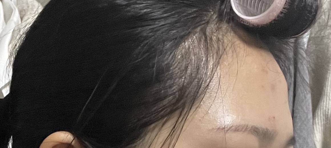 before photo: 이마필러