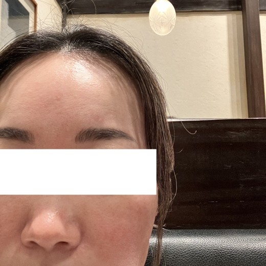 before photo: ララピール(LHAピーリング)