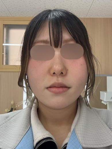 after photo: 糸リフト, 脂肪吸引(顎下), 脂肪吸引(顔), 脂肪吸引(頬)
