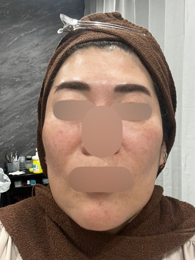 before photo: ヴェルベットスキン