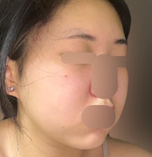 after photo: 윤곽주사, 얼굴지방분해주사