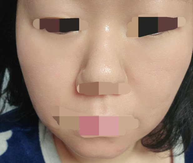 after photo: 아쿠아필링