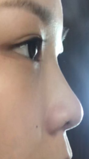 before photo: 콧대(보형물), 코끝(자가연골)