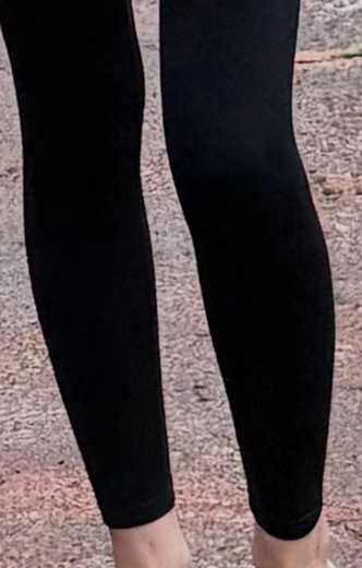 after photo: 종아리보톡스