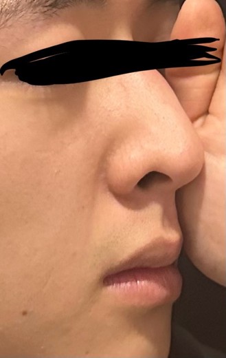 before photo: 콧대(자가조직), 콧볼축소