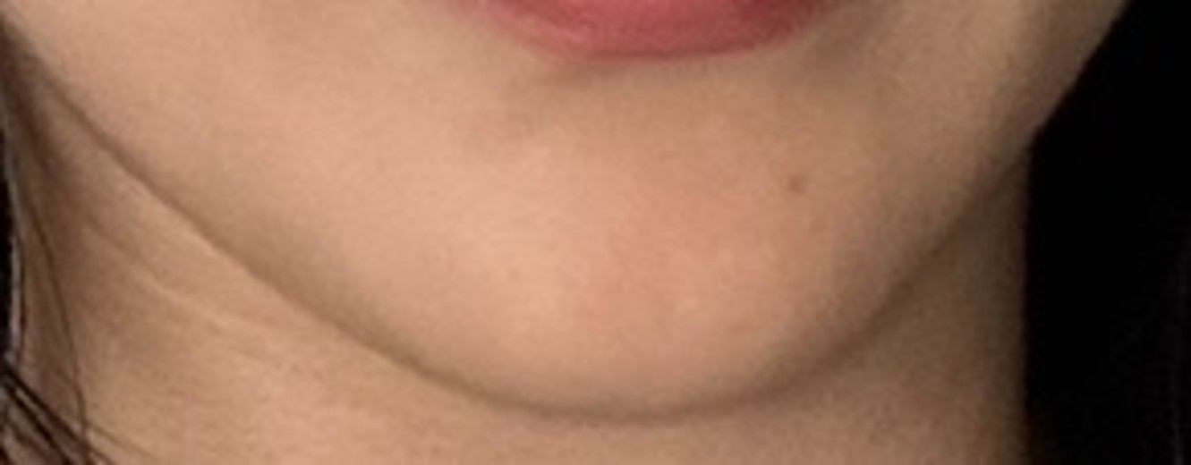 after photo: 윤곽주사