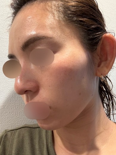 after photo: エクソソーム, ピコトーニング