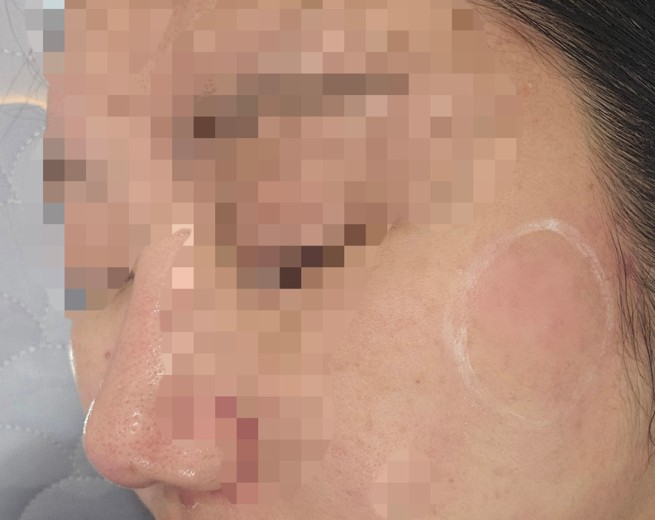 after photo: 리팟레이저