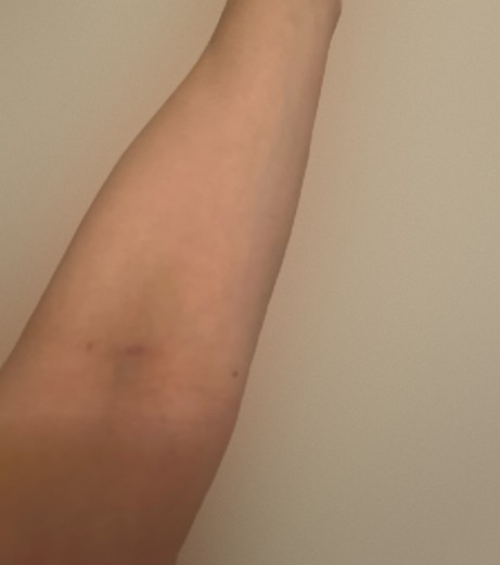 after photo: 白玉注射・点滴, 美容注射・点滴