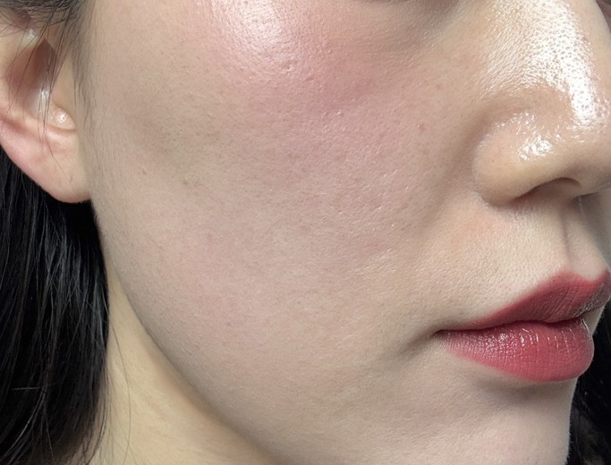 after photo: 리쥬란힐러