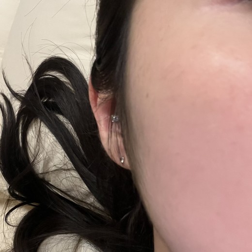 after photo: 사각턱보톡스