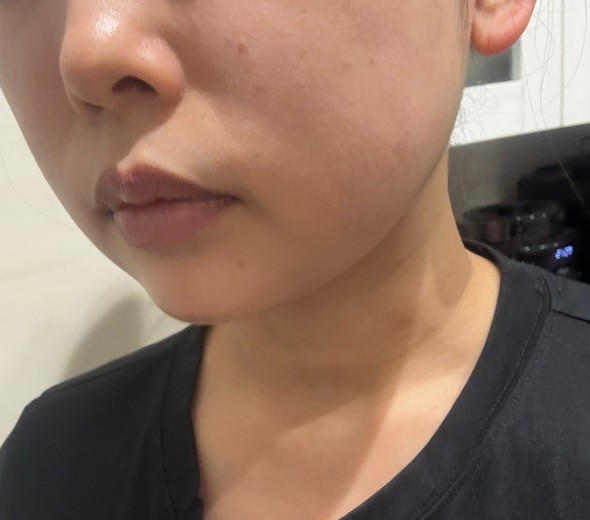 after photo: あごヒアルロン酸, 頬ヒアルロン酸