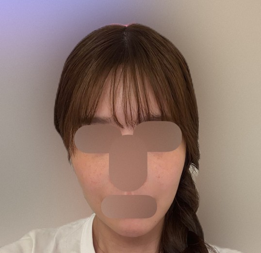 before photo: インモード