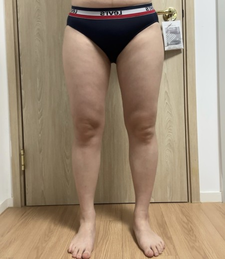 after photo: 허벅지지방흡입