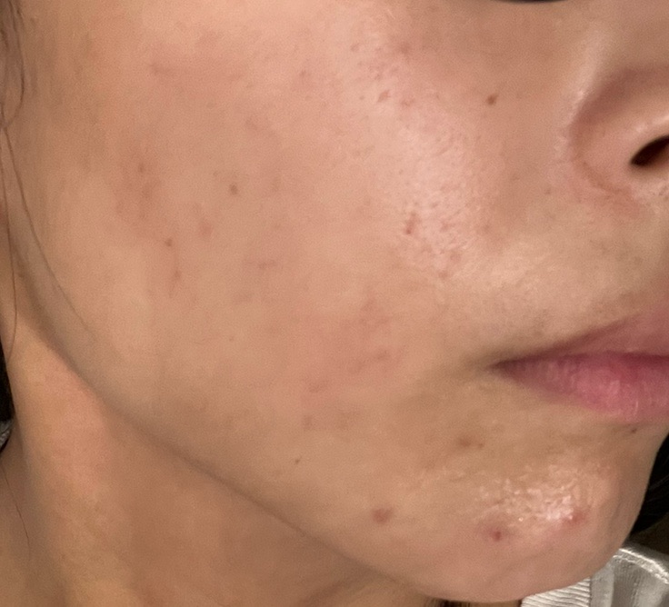 GSD フォトフェイシャル GSD フォトフェイシャル フォトフェイシャル | ZX-CLINIC【公式