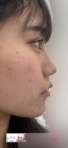 after photo: 脂肪吸引(腕)