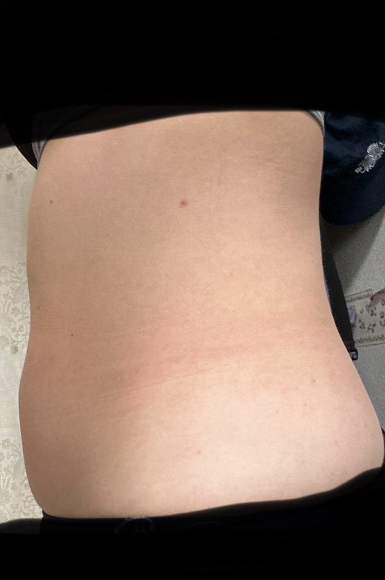 いまだけキャンペーン！冷却　脂肪冷却 2ハンドル いまだけキャンペーン！冷却 脂肪冷却 2ハンドル いまだけキャンペーン