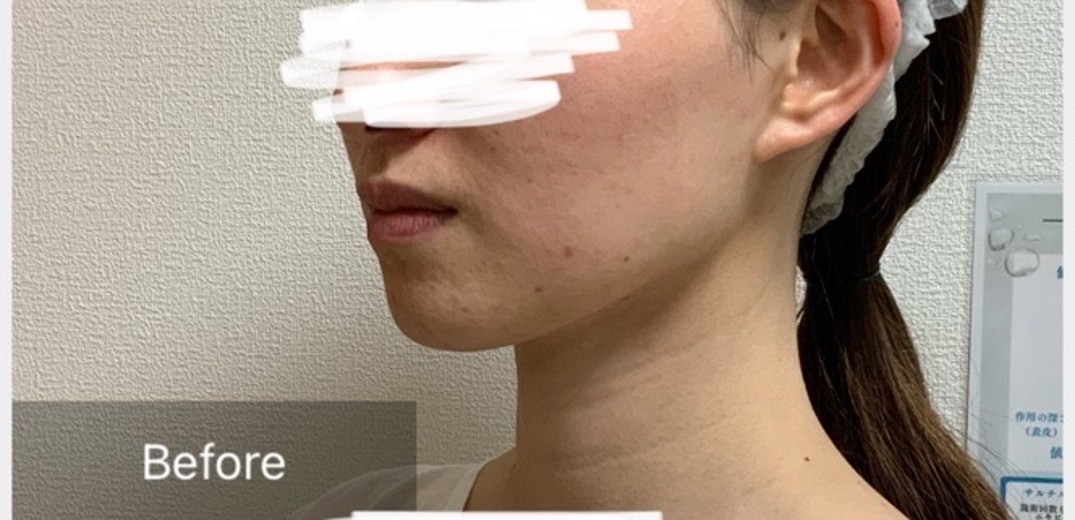 before photo: チタニウムリフト