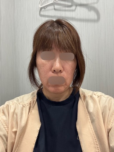before photo: ヴェルベットスキン