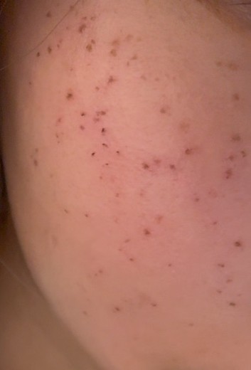 after photo: IPL(光/フォト治療), 診断・検査