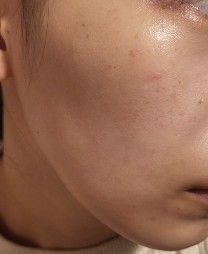 after photo: IPL(光/フォト治療), 診断・検査