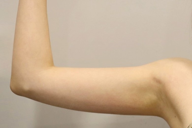 after photo: 팔지방분해주사