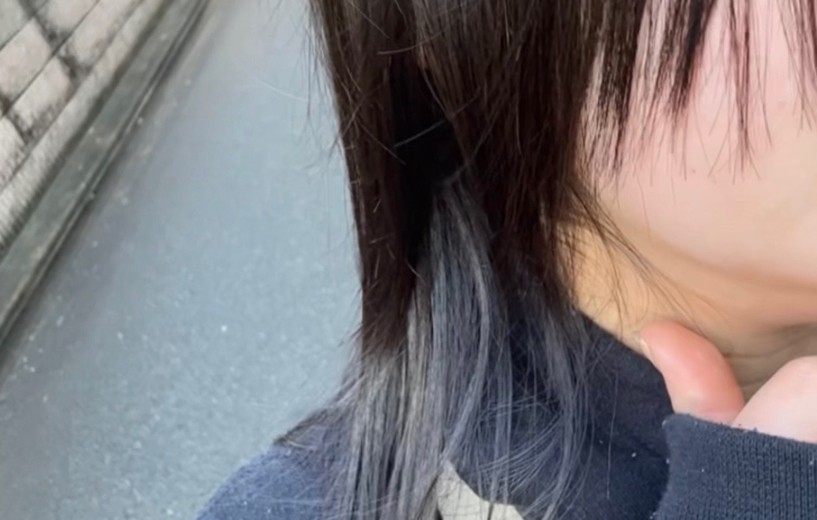 before photo: 脂肪溶解注射(顔)