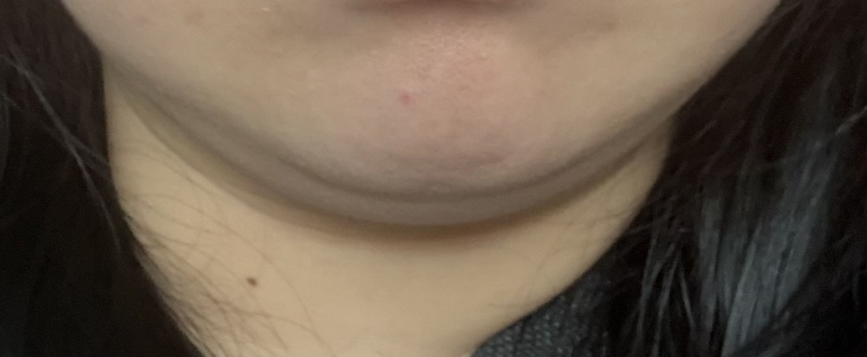 before photo: 윤곽주사