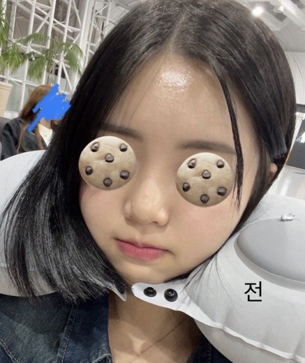 before photo: 콧대(보형물), 코끝(자가연골)