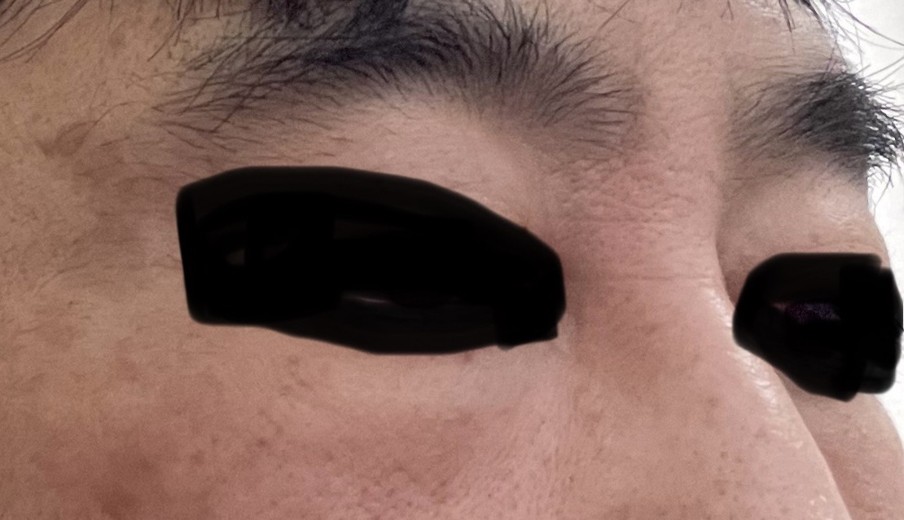 after photo: サーモン注射