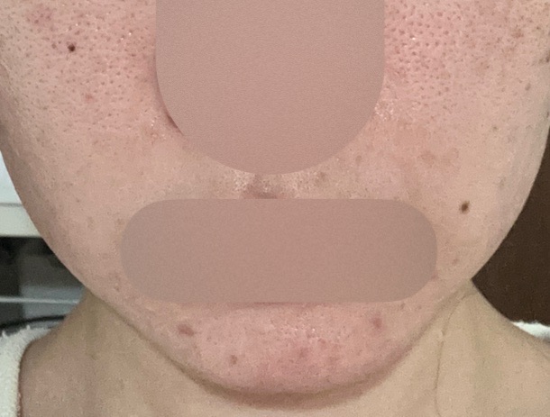 再来OK】ハイドラフェイシャル＋エレクトロポレーション | おおかみ