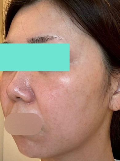 before photo: IPL(光/フォト治療), ルメッカ