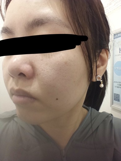 before photo: ダーマペン