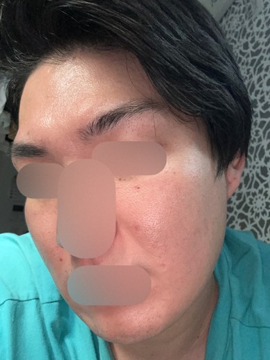 after photo: ダーマペン