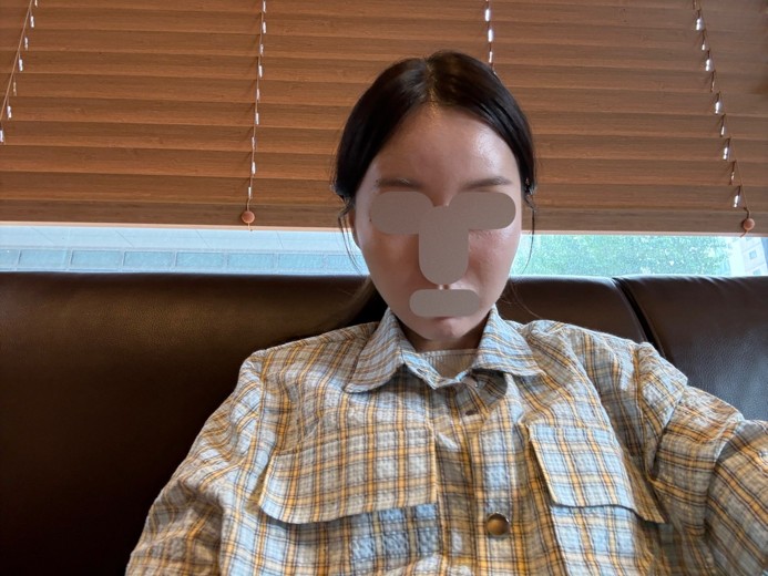 after photo: 실리프팅