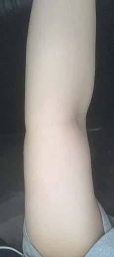 after photo: 脂肪吸引(腕)