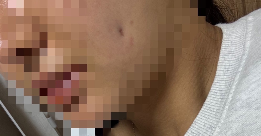 after photo: 보조개성형