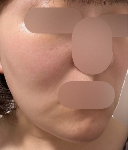 after photo: ルメッカ