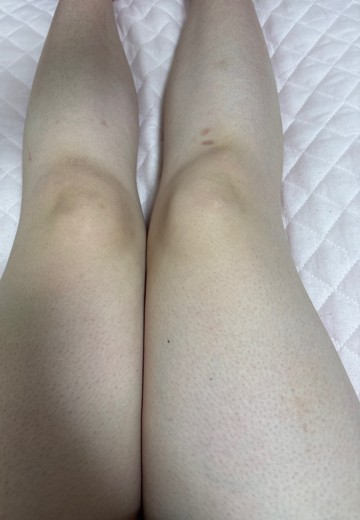after photo: 高周波脂肪溶解(太もも)