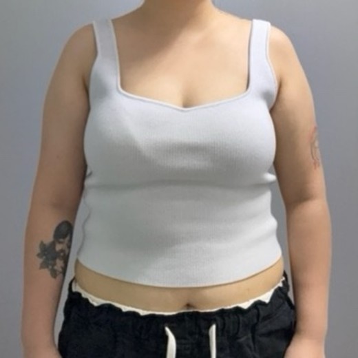 before photo: 脂肪溶解注射(腕)