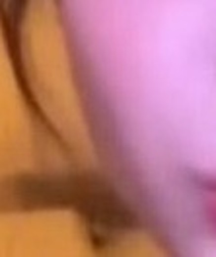 after photo: 윤곽주사