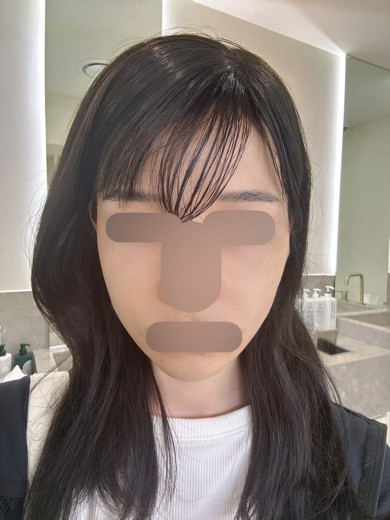 after photo: ララピール(LHAピーリング)