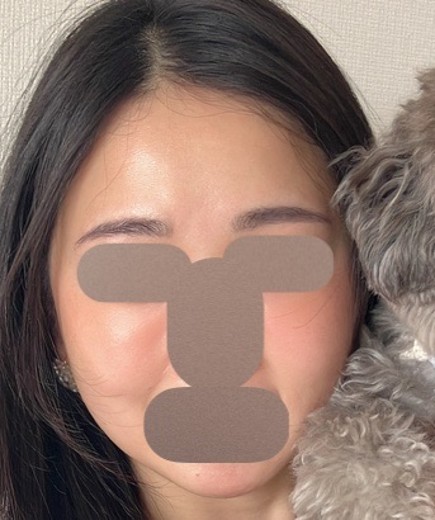 after photo: 白玉注射・点滴, ルメッカ