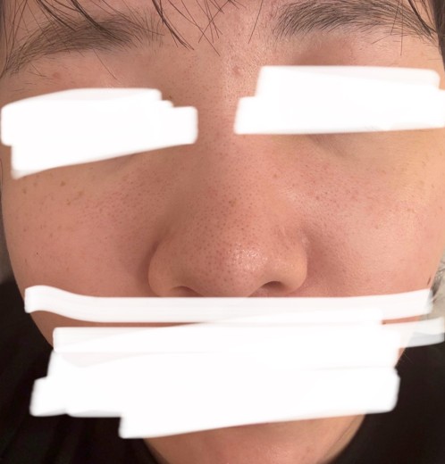 after photo: ハイドラフェイシャル