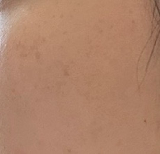 after photo: IPL(光/フォト治療)