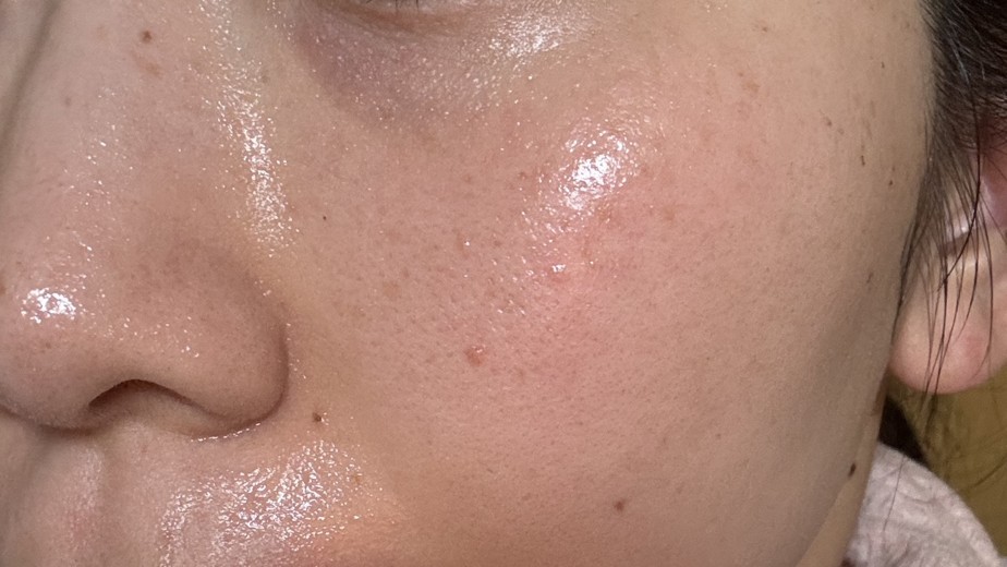 after photo: IPL(光/フォト治療)