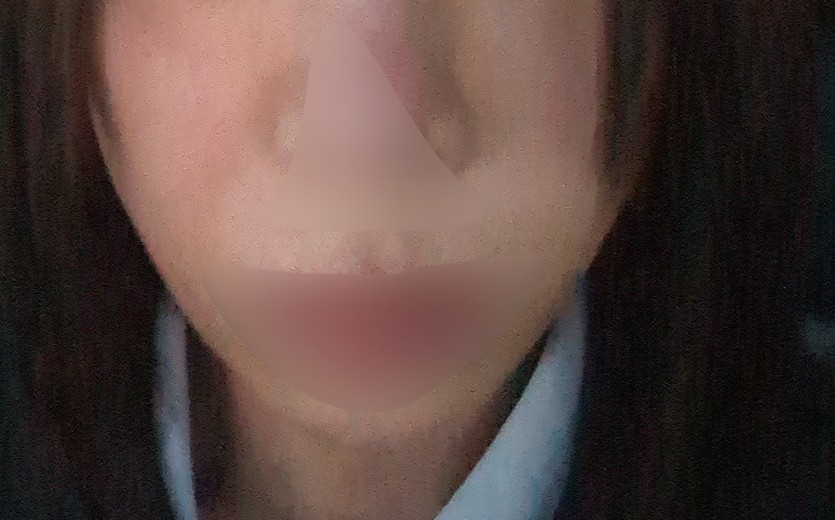 after photo: 糸リフト, メーラー/ジョール/バッカルファット除去