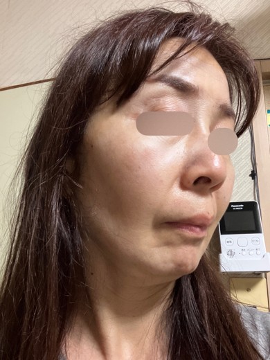 after photo: エレクトロポレーション